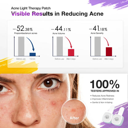 Advertisement for Viva Glam acne light therapy patches showing before and after effects on a person's face.